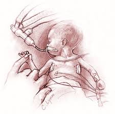 πρόωρος τοκετός